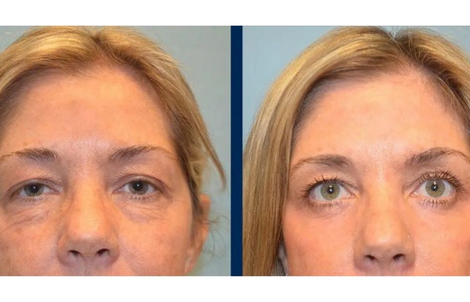 CO2 Laser Resurfacing Before and After